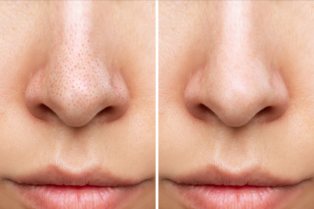 Why Cleansing After Wearing Makeup is a Must