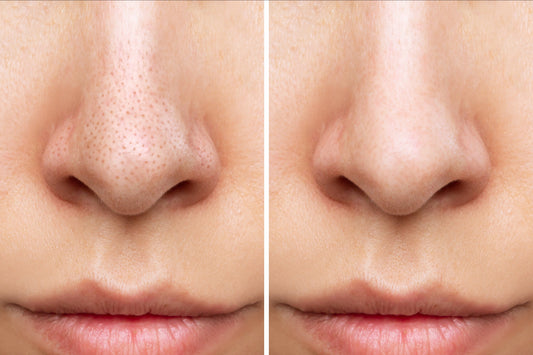 Why Cleansing After Wearing Makeup is a Must